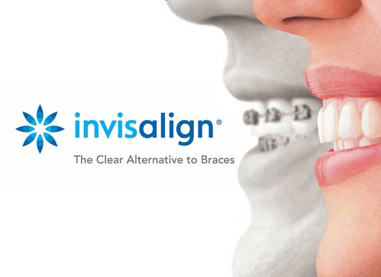 life-with-invisalign