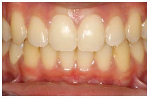 After-Deep-Bite-Treatment