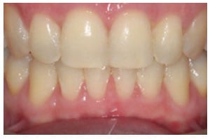 After-Deep-Bite-Treatment