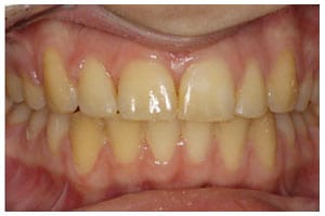 After-Deep-Bite-Treatment