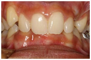 Before-Deep-Bite-Treatment