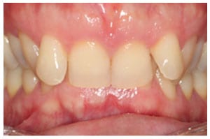 Before-Deep-Bite-Treatment