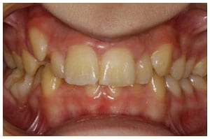 Before-Deep-Bite-Treatment